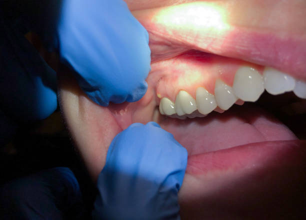 Best Emergency Root Canal Treatment in Little River Academy, TX